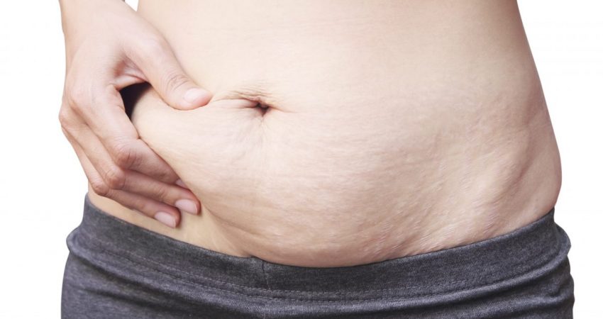 Barriga Pós Parto - Como Eliminar